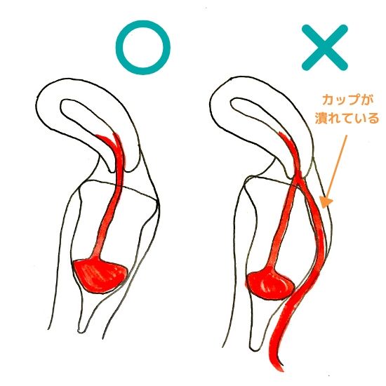 どうして 月経カップが漏れしまう５つの原因と今すぐできる対処法 エマブログ