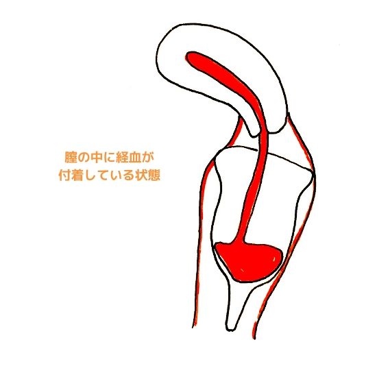 どうして 月経カップが漏れしまう５つの原因と今すぐできる対処法 エマブログ